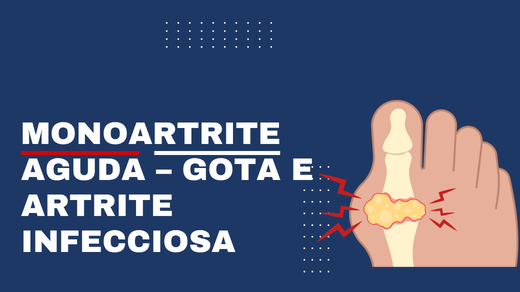 Monoartrite aguda – gota e artrite infecciosa