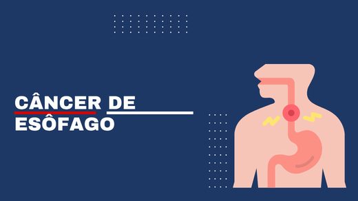 Câncer De Esôfago