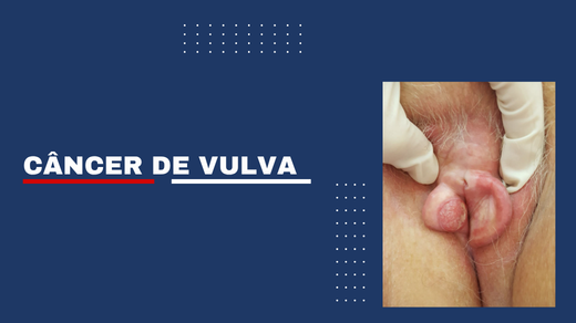 Câncer De Vulva
